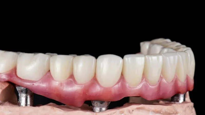 Impianti In Zirconia in Albania - Clinica Dentale Albania | Tirana e Valona